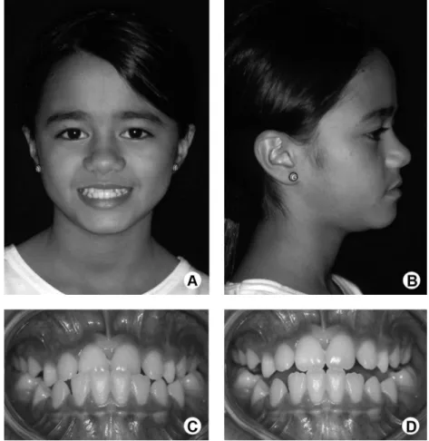 Figure 1. A and B: Initial extraoral photographs. C: Initial intraoral photographs at intercuspal position