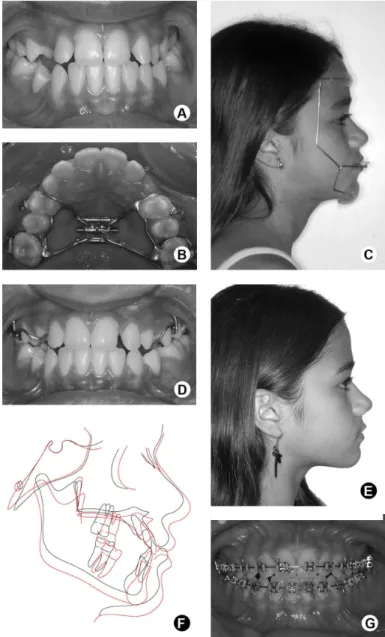 Figure 2. A: Intraoral photographs showing pre-expansion aspect. B: Hyrax-type  expander