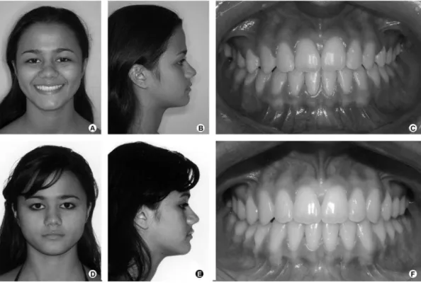 Figure 3. Final extraoral (A and B) and intraoral (C) aspects. Three-year post-treatment follow-up: extraoral (D and E) and intraoral photographs (F)