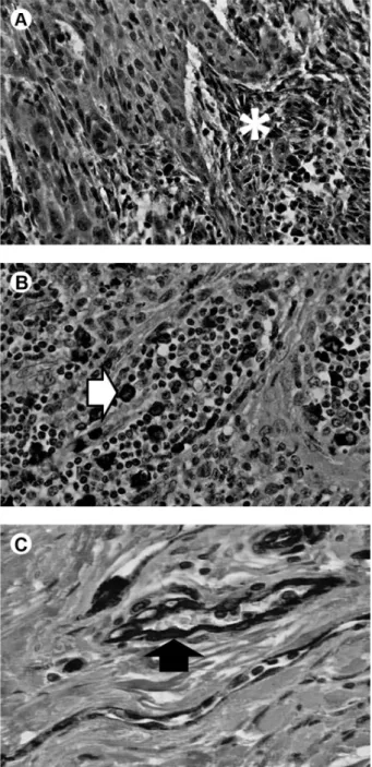 Figure 1. Immunohistochemical evaluation of SCC of the floor of the  mouth. A: Positive staining for MMP-2 in the connective stroma (*)