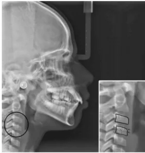 Figure 1. Delineation of C4 vertebral height and length.