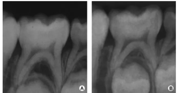 Figure 3. Radiograph of carious lesion in primary mandibular right  second molar (NLG) at baseline (A) and 12-month follow-up period (B)