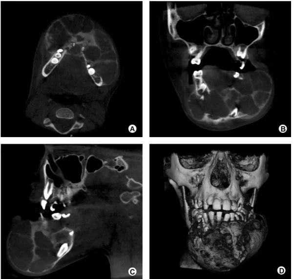 Figure 2. CBCT axial (A), coronal (B) and sagittal (C) scans showing an extensive multilocular, hypodense area, causing severe enlargement of the  cortical vestibular bone with disruption at some points and dislocation of the tooth germs