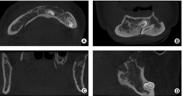 Figure 4. CBCT axial (A), coronal (B and C) and sagittal (D) scans showing osteolytic lesions extending from the base to the mandibular ramus, causing  bone loss and displacement of teeth to the base of the mandible.