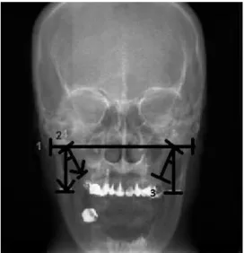 Figure 2. Measurement of the medial angulation of the styloid process  using the posteroanterior skull radiograph (reverse Towne’s projection).