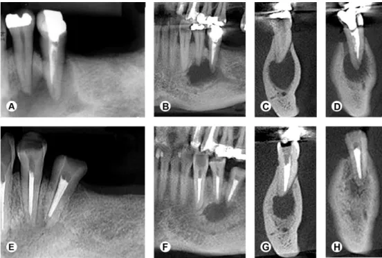 Figure 1. Composite image of periapical radiographs and CBCT scans of mandibular premolars and canine associated with large AP and primary and  secondary infections (A-H)