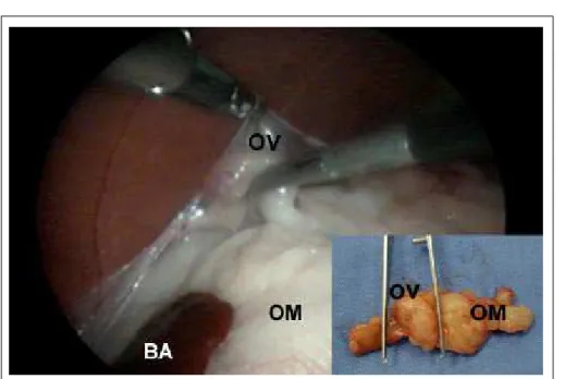 Figura 1 - Ovário remanescente (OV) em uma gata com síndrome do ovário remanescente submetida à OSH convencional