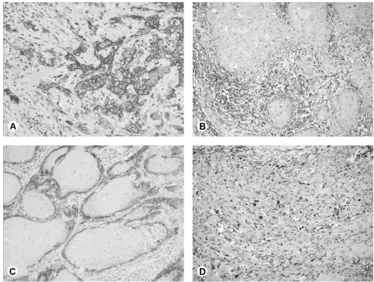 Figure 2. A: Immunoexpression of GLUT-1 in the invasive front of high-grade LLSCC (Advance, 400×)