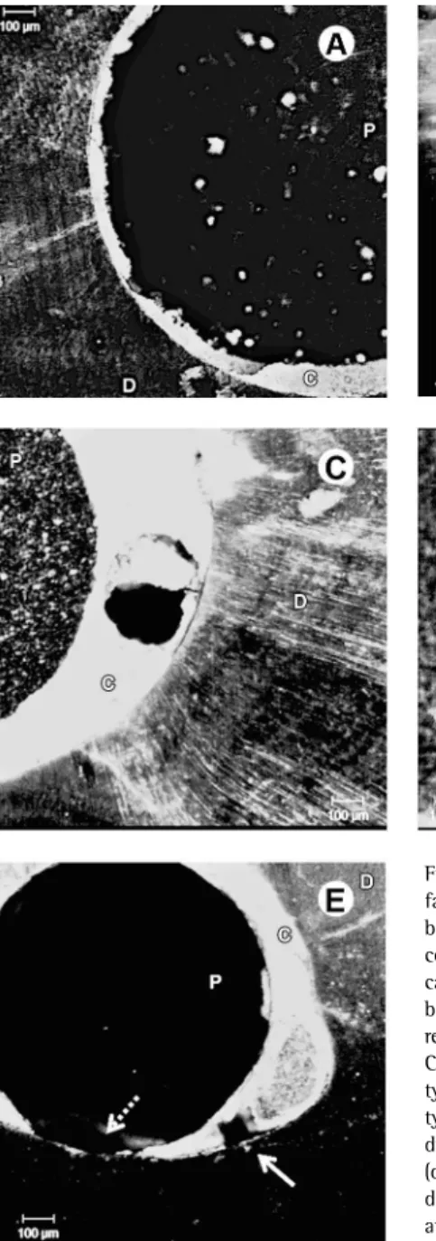 Figure 1. Confocal microscope images of  failure modes: A: type I failure, adhesive  between post and luting cement with resin  cement entirely covers the dentine root  canal walls; B: type II failure, adhesive  between dentin and luting cement with the  r