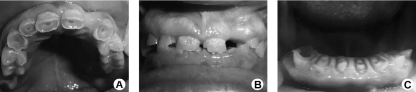 Figure 1. Initial condition showing a marked reduction of tooth length and consequent occlusal collapse with pronounced loss of occlusal vertical  dimension and irregular occlusal plane