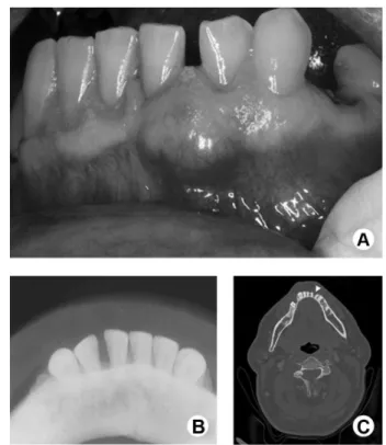 Figure 1. A: Nodule on the vestibular region between the mandibular left  incisors. B: Occlusal radiograph showing absence of central involvement