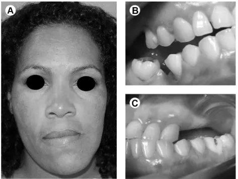 Figure 1. A: Severe derangement of occlusion - cant of occlusion. B: Left crossbite. C: right  posterior open bite.