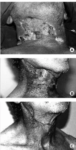 Figure 1. A: Consistent, diffuse, erythematous and vesicular swelling in  the submandibular and cervical regions