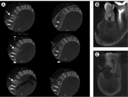 Figure 3. Cone beam computed tomography (CBCT): axial (A), sagittal (B) and coronal (C)  sections