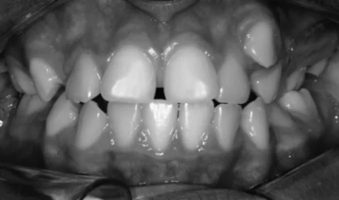 Figure 1. Initial intraoral clinical aspect of the patient.