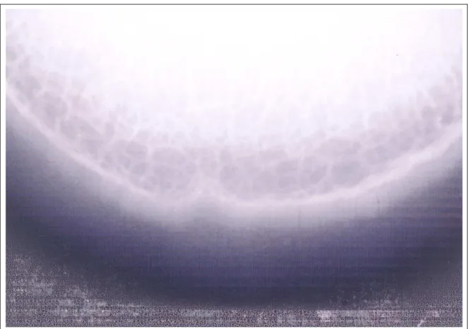 Figura 2 - Radiografia contrastada em projeção dorsopalmar da falange distal de um eqüino após tratamento por calor com evidência das lâminas dérmicas.