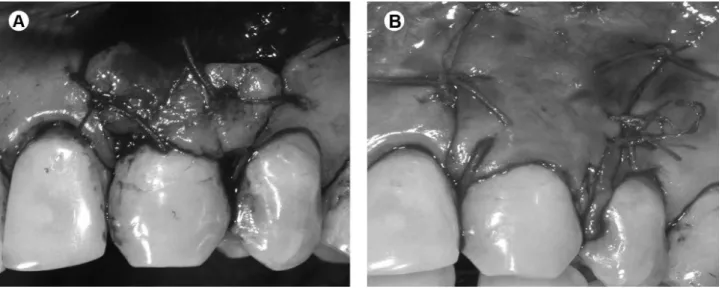 Figure 1. SCTG group. A: Connective tissue graft sutured over the recipient site. B: Flap positioned coronally and sutured.