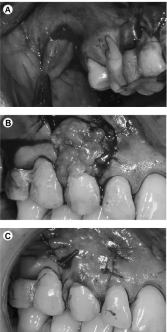 Figure 2. BFPG group. A: Removal of buccal fat pad. B: BFPG sutured  over the recipient site
