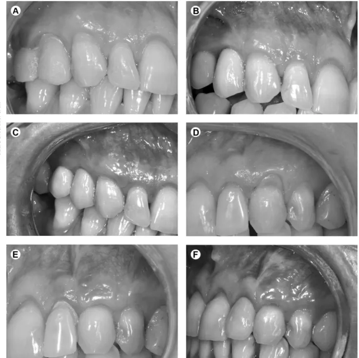 Figure 3. A: BFPG group.  Maxillary right canine with Miller Class I gingival recession at baseline