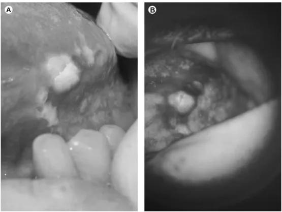 Figure 1. A: Clinical image of the lesion. B: Visualization with VELscope®.