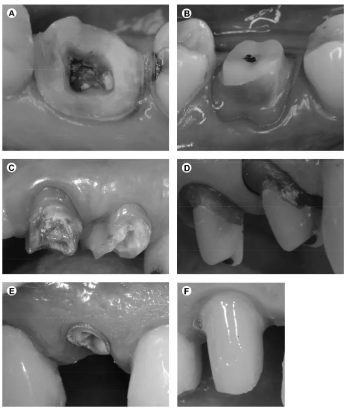 Figure 1. Group A (Top): maximum amount of remaining coronal dentin located at the gingival margin before (left column) and after (right column)  post cementation and preparation design – no ferrule effect