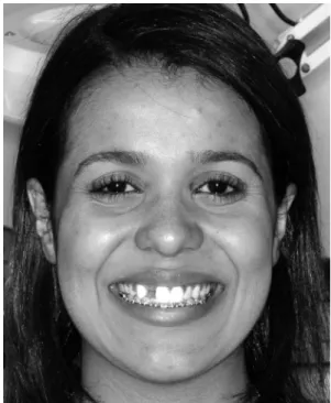 Figure 1. Pretreatment condition, showing the frontal view during smile.