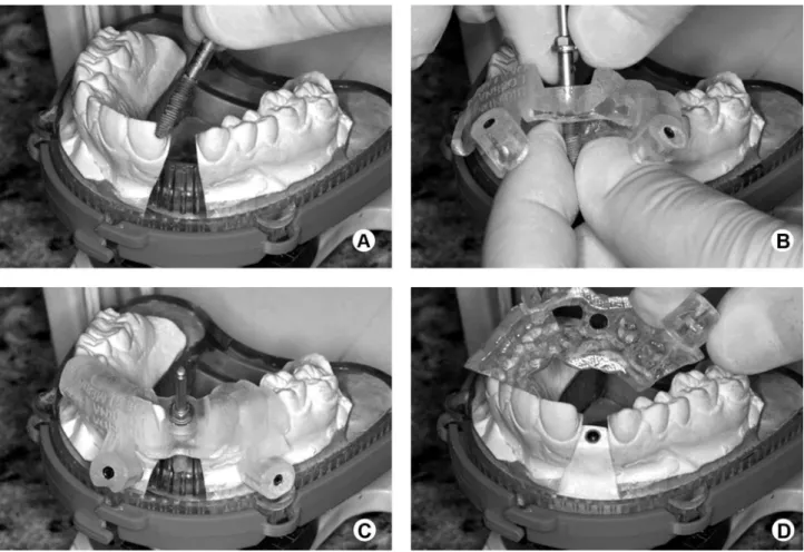 Figure 3. Fixation of an implant in the master cast using a stereolithographic surgical template