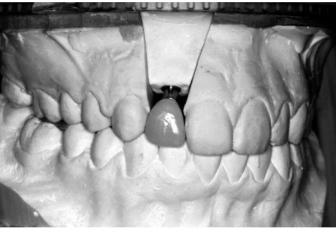 Figure 6. Abutment connection using the indexing device. Figure 7. Definitive zirconium crown.