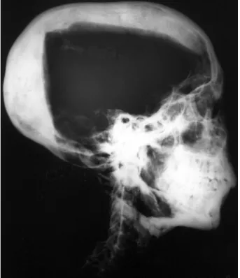 Figure 3. Lateral face reconstruction of pharaoh Tutankhamun. The  shape of the nose is notional.
