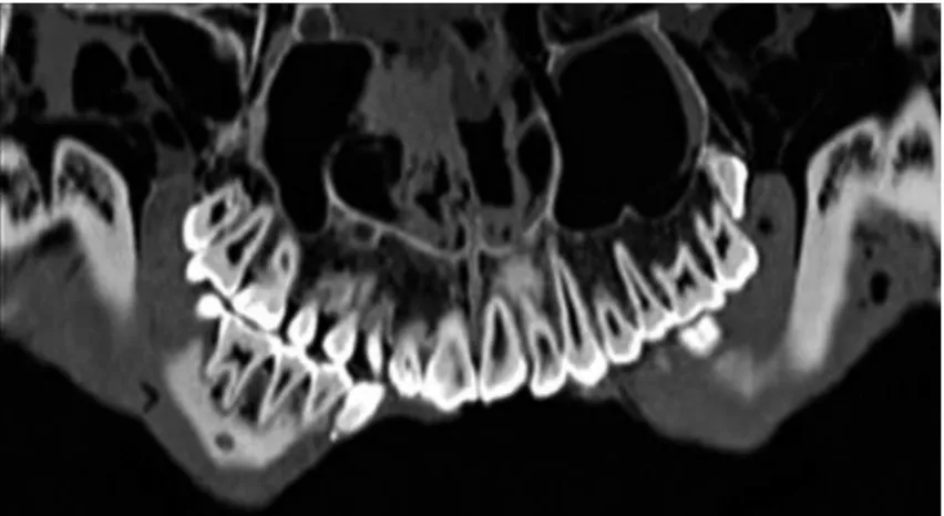 Figure 4. Cephalometric analysis according to Segner and Hasund,  based upon Figure 2