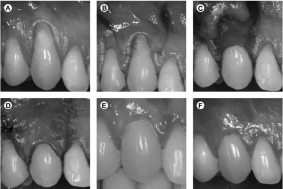 Figure 1. Control group. A: Baseline. B: Incisions. C: PCM sutured. D: Flap sutured. E: Clinical aspect after 3 months