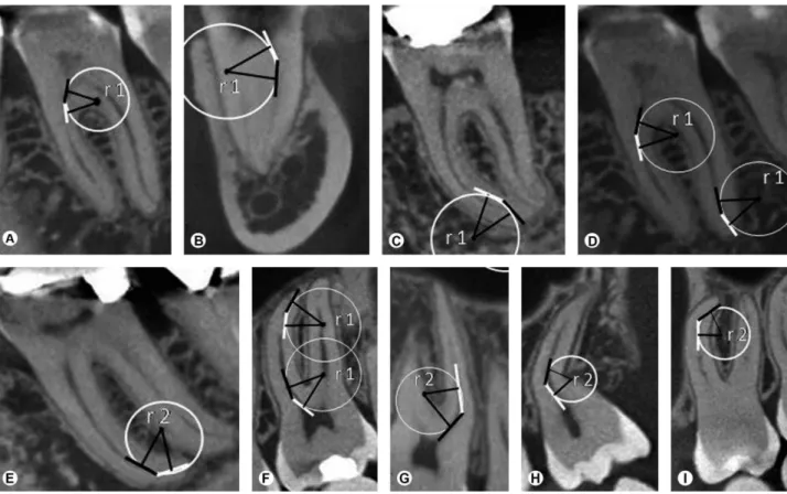 Figure 2 (A-I) Illustrations of curvature radii method showing cervical and apical curvature in sagittal and coronal planes in mandibular and  maxillary molars.