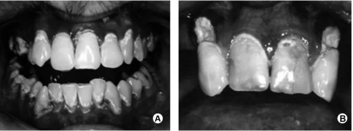 Figure 1. A. Case 1: Incipient clinical patterns of cGVHD-related caries can be seen as generalized superficial carious lesions predominately involving  cervical and incisal areas of anterior and posterior teeth