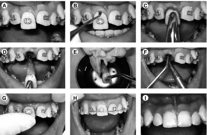 Figure 1. A: Initial intraoral picture showing the extrusion of the tooth 11. B: Syndesmotomy