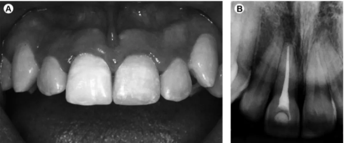 Figure 3. Clinical (A) and radiographic (B) aspect of the tooth at 49 months after treatment.