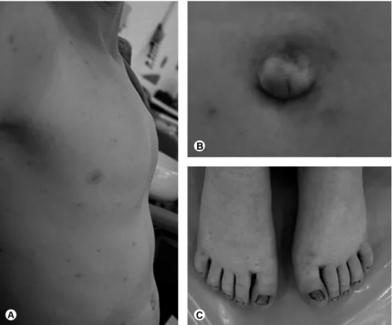 Figure 1. Physical characteristics: A: pectus excavatum; B: umbilical hernia; C: hypoplastic nails.