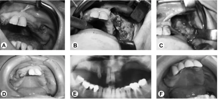 Figure 1. A: Initial aspect of the necrotic area. B: Extension of the necrotic area beyond the initially exposed area