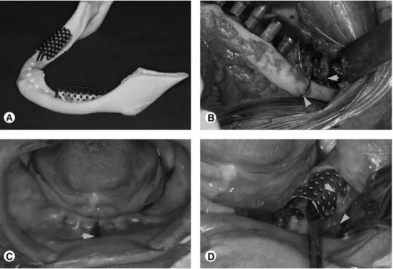Figure 1. A: Edentulous mandible presenting severe resorption; B. Cone  beam computed tomography (CBCT) scanning showing a mandible  with reduced bone mass class VI, according to Cawood and Howell (2).
