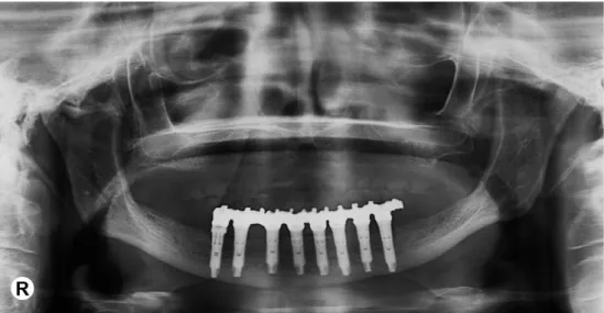 Figure 4. Panoramic radiograph 1 year after the fixed dental implants prosthesis placement  showing significant gain in the bone height in whole  residual alveolar ride.