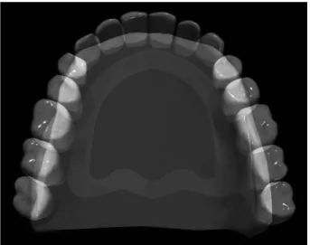 Figure 3. Diagrammatic representation of a maxillary complete denture. 