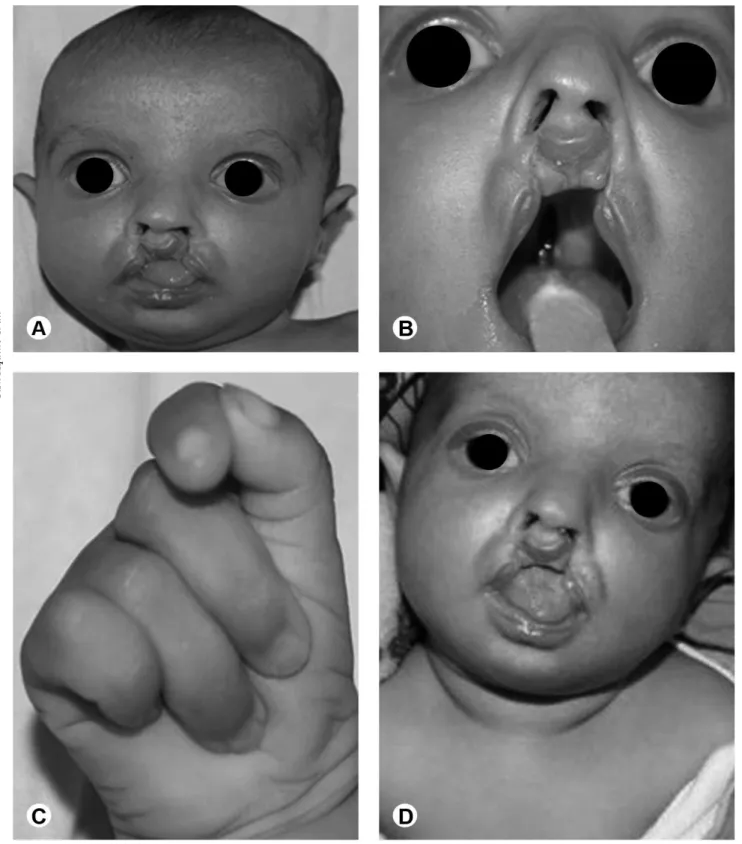 Figure 2. Craniofacial abnormalities including Greek warrior helmet appearance (A) and bilateral incomplete cleft lip and incomplete cleft palate (B)