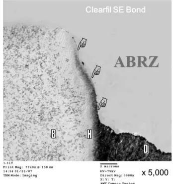 Figure 9. SEM images of the enamel-adhesive interfaces after acid-base challenge. The formation of enamel ABRZ with a two-step self-etch adhesive  system, which contains MDP as the acidic functional monomer (left), while the enamel ABRZ could not be distin