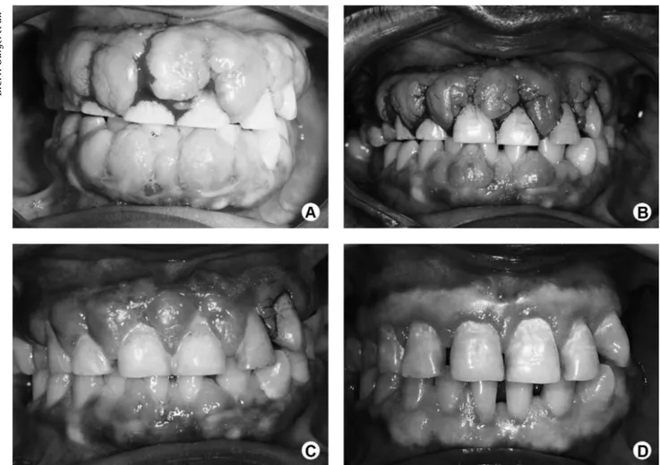 Figure 1. A: Buccal view before treatment. Intraoral examination showing generalized edematous gingival tissue