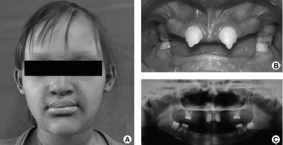 Figure 1. A: Patient with clinical characteristics of ectodermal dysplasia. B: Frontal intraoral view before oral rehabilitation