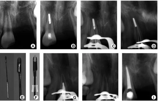 Figure 1. Sequence of fragment removal in case 1. A: A radiograph provided by the patient showing the condition of the maxillary left central incisor  immediately after trauma 1 year previously