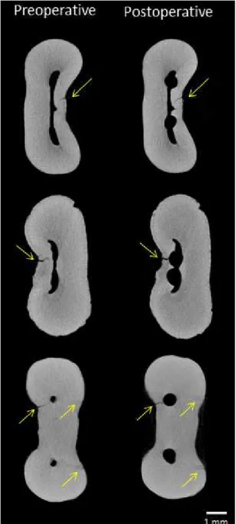 Figure 1. Micro-CT cross-section images of the mesial roots showing  the presence of dentinal micro-cracks (arrows) before and after root  canal preparation.