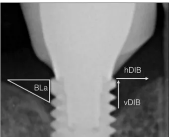 Figure 1. Software-assisted assessment of the distance between the  outer edges of the implant platform to the first visible crestal bone  vertically (vDIB) and horizontally (hDIB); and the bone loss area (BLa)  circumscribed between vDIB and hDIB.