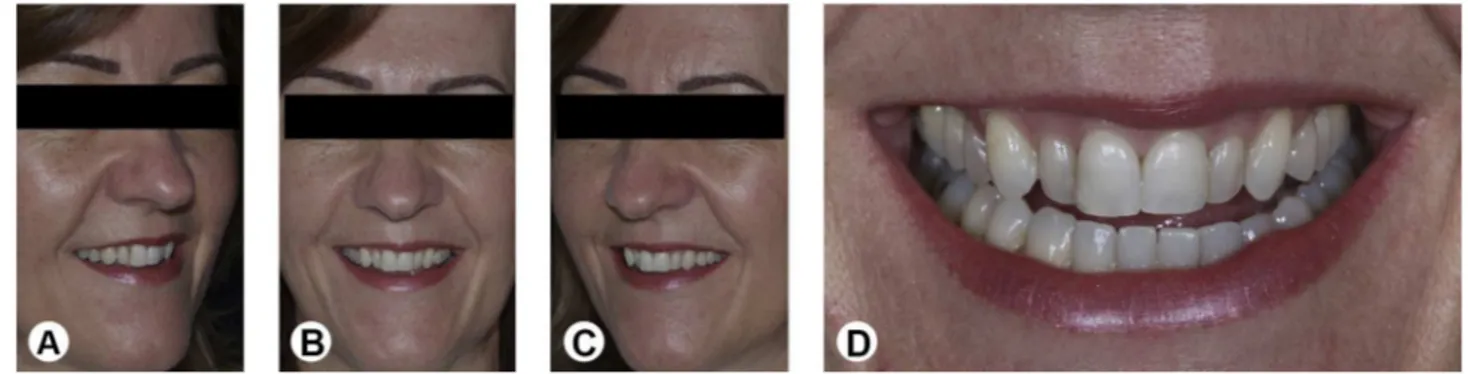Figure 1. Pretreatment facial (A-C) and close-up smile (D) views.