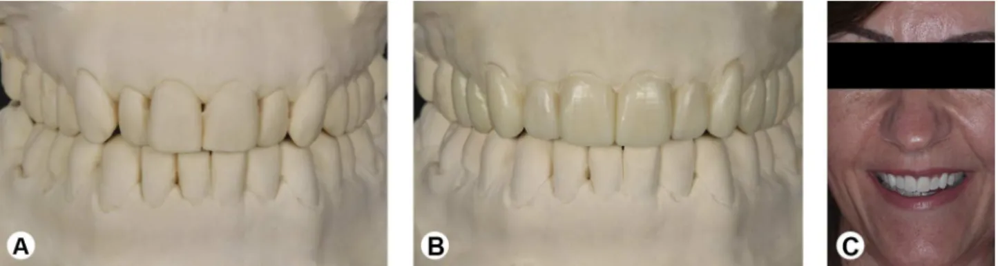 Figure 3. Casts articulated in maximum intercuspation (A), diagnostic wax-up (B), and facial view with diagnostic mock-up using bis-acryl  composite resin (C).