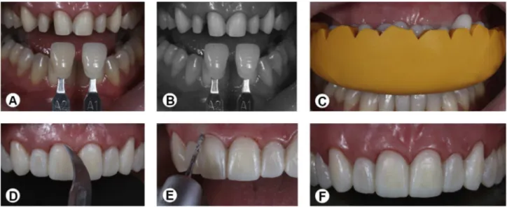 Figure 5. Photographic evaluation for shade matching (A, B). Provisional restorations made using bis-acryl composite resin with a silicone mold (C-F).